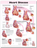 Heart Disease Anatomical Chart Paper Unmounted