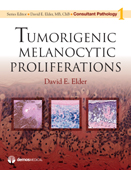 Tumorigenic Melanocytic Proliferations