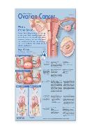 Understanding Ovarian Cancer Anatomical Chart Laminated