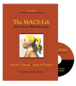 The MACS-Lift: Short-Scar Rhytidectomy  + DVD